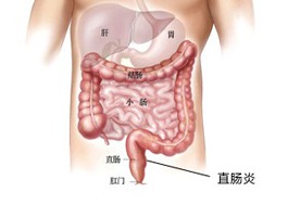 襄阳治疗慢性直肠炎的方法